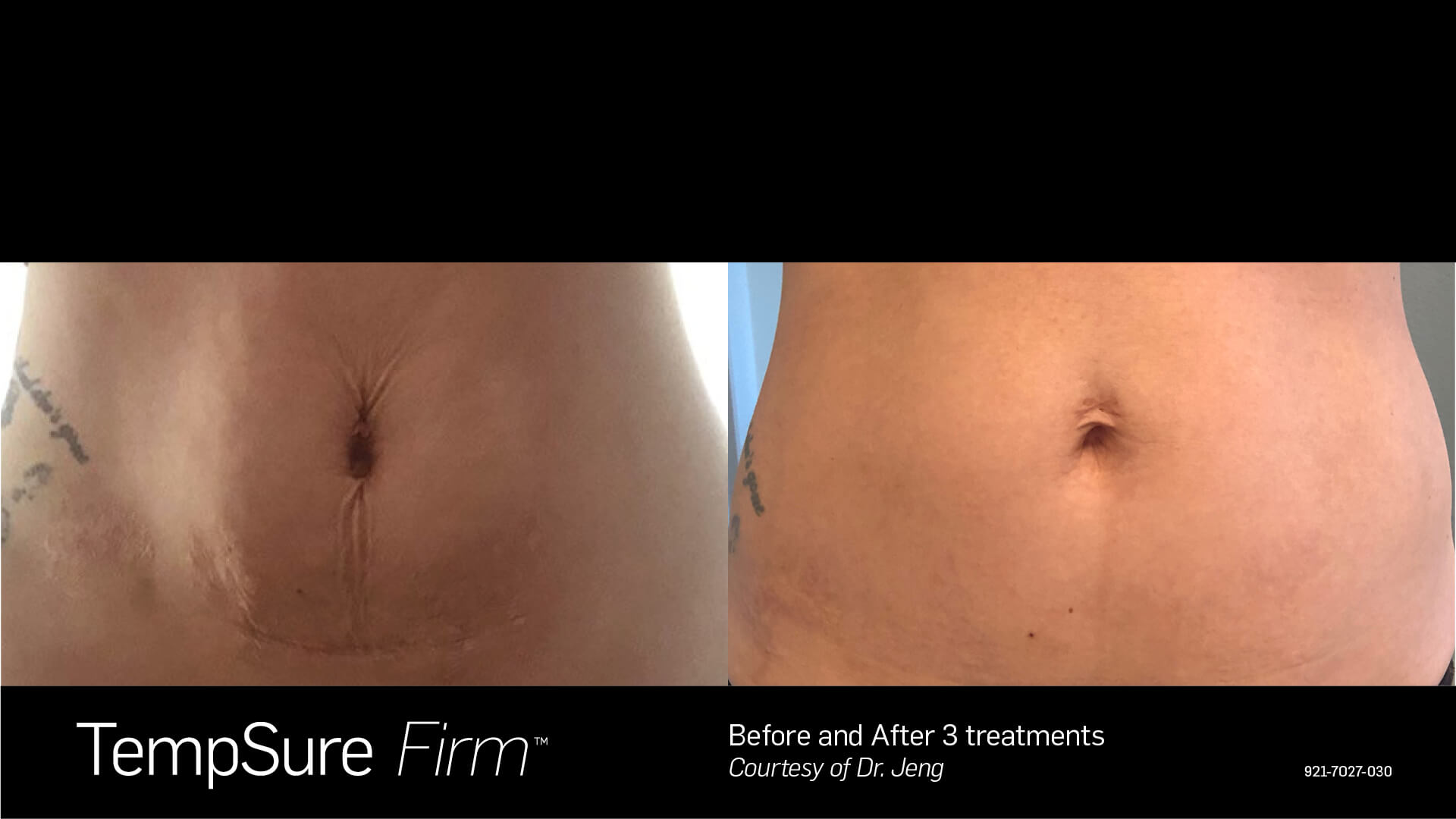 Before and After Photo | TempSure Firm | Cellulite Reduction