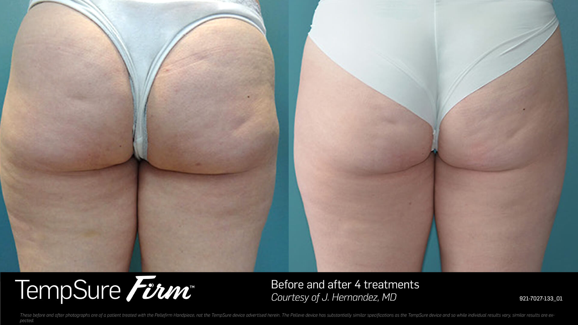 Before and After Photo | TempSure Firm | Cellulite Reduction