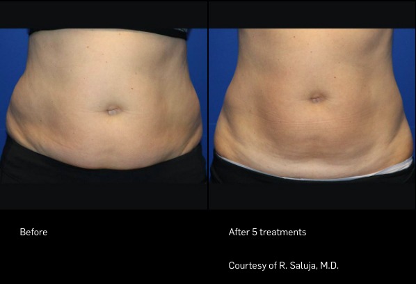 Before and After Photo | FlexSure | Body Contouring