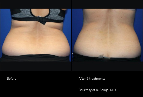 Before and After Photo | FlexSure | Body Contouring