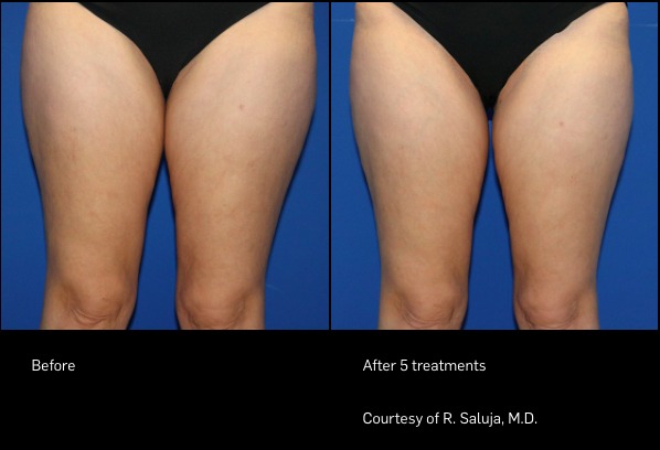 Before and After Photo | FlexSure | Body Contouring