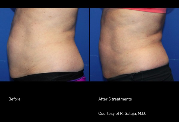 Before and After Photo | FlexSure | Body Contouring