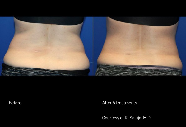 Before and After Photo | FlexSure | Body Contouring