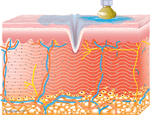 Collagen Synthesis Begins | TempSure Envi | Skin Tightening