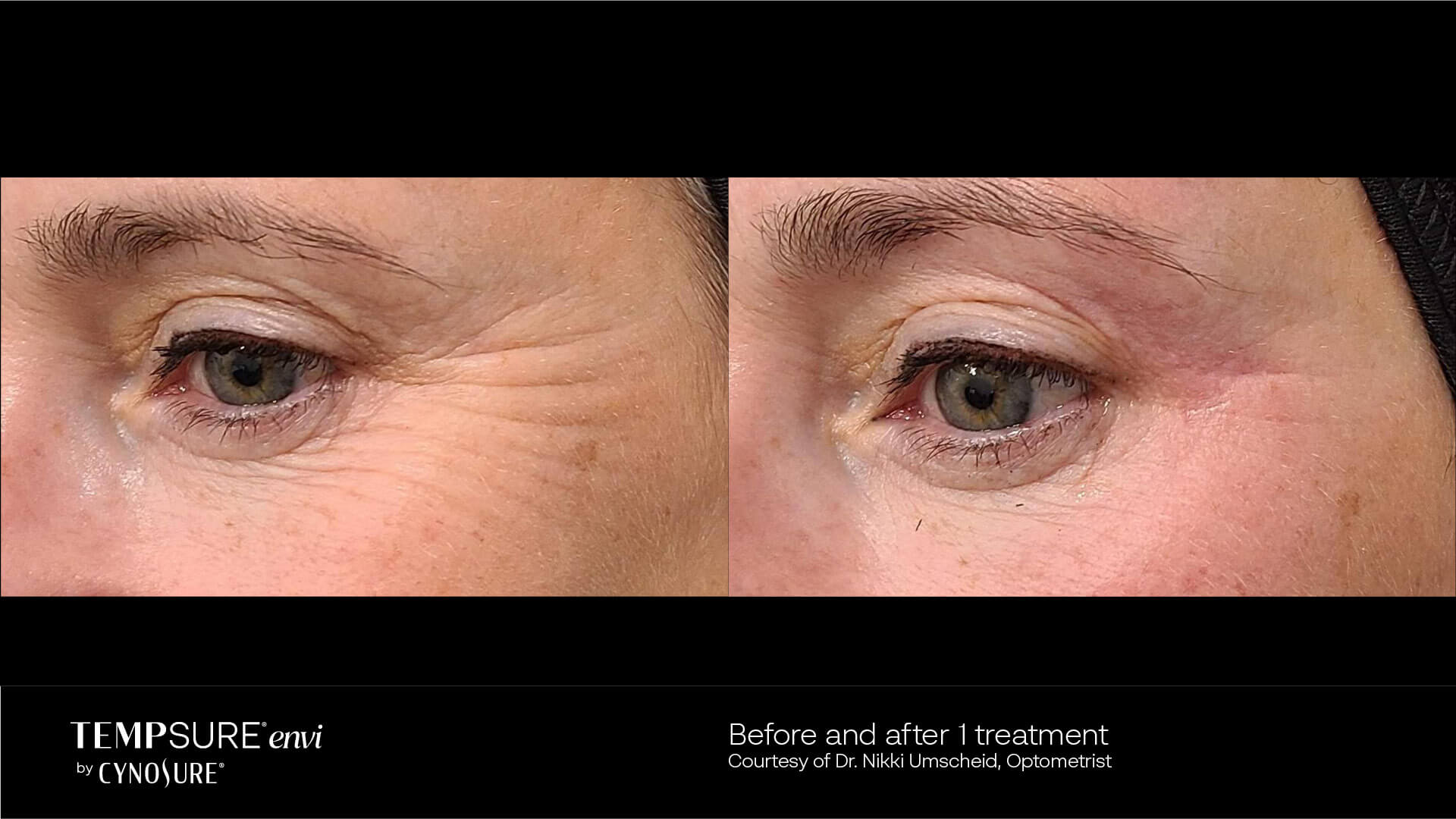 Before and After Photo | TempSure Envi | Skin Tightening