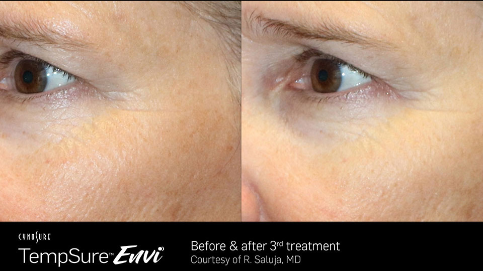 Before and After Photo | TempSure Envi | Skin Tightening