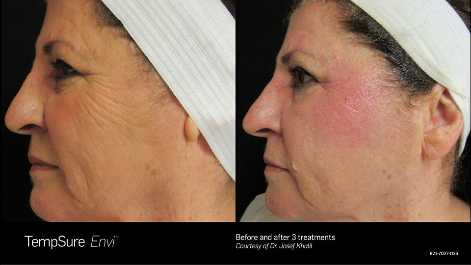 Before and After Photo | TempSure Envi | Skin Tightening