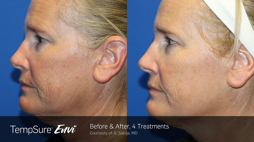 Before and After Photo | TempSure Envi | Skin Tightening