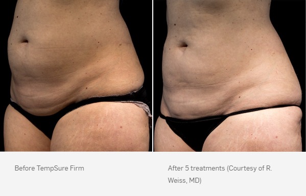 Before and After Photo | TempSure Firm | Cellulite Reduction