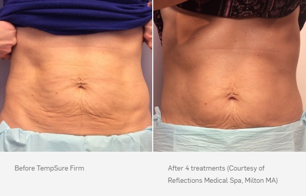 Before and After Photo | TempSure Firm | Cellulite Reduction