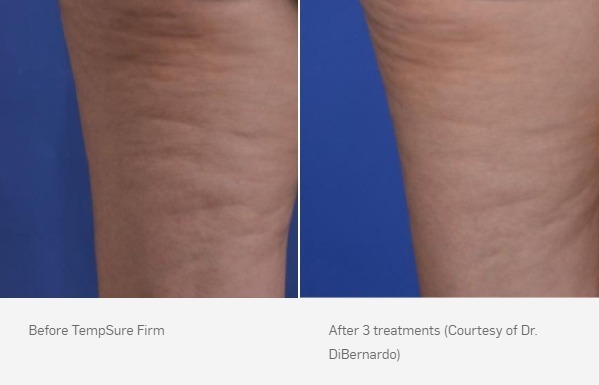 Before and After Photo | TempSure Firm | Cellulite Reduction