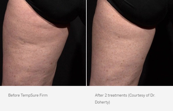 Before and After Photo | TempSure Firm | Cellulite Reduction