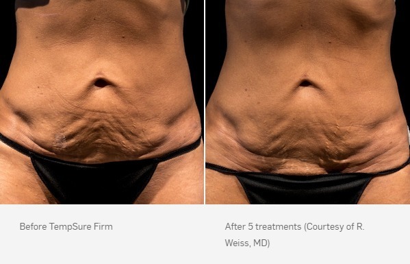 Before and After Photo | TempSure Firm | Cellulite Reduction