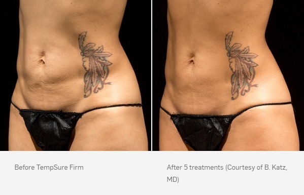 Before and After Photo | TempSure Firm | Cellulite Reduction