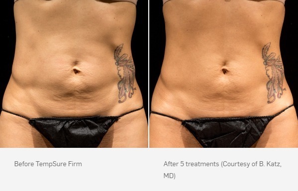 Before and After Photo | TempSure Firm | Cellulite Reduction