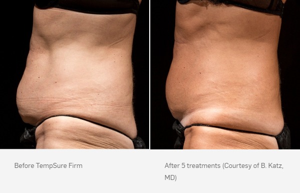 Before and After Photo | TempSure Firm | Cellulite Reduction